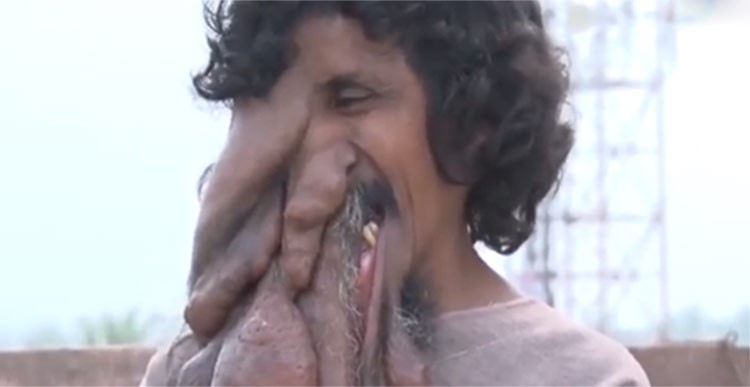 بالفيديو.. "الرجل الفيل" يتحول الى أسطورة عالمية