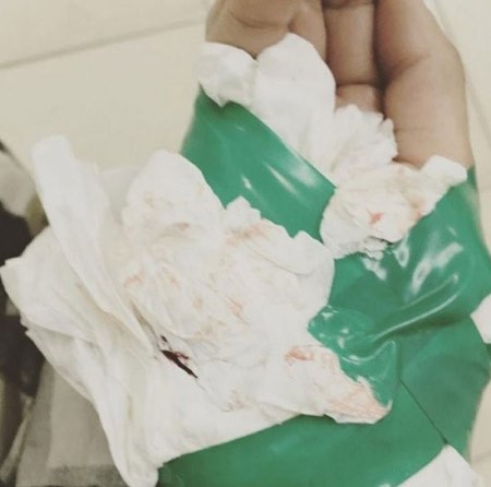 بالصور.. شيلاء سبت تجري عملية جراحية وهي ترتدي نظارتها الشمسية