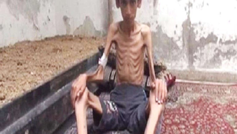 صورة بثها ناشطون لاحد سكان مضايا الذي اضناه الجوعالعربيةنت