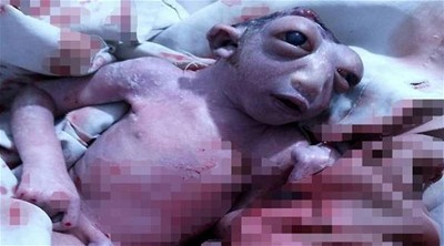 صورة: طفلة تولد بنصف رأس وعينين ضخمتين تذهل الأطباء