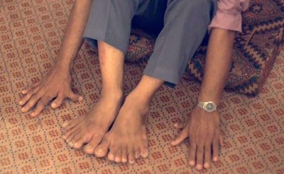 بالفيديو.. لديه 28 إصبعاً ويعتبر نفسه محظوظاً