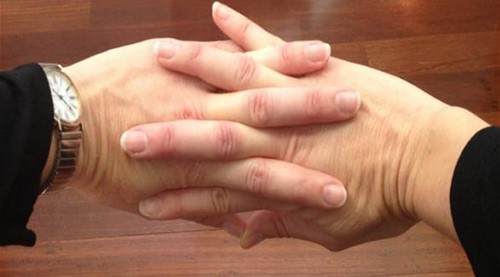 هل "طقطقة" المفاصل ضارة؟ 