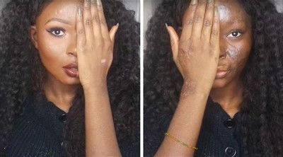 بالصور.. أصبحت فنانة ماكياج بعد سخرية الجميع من حروقها