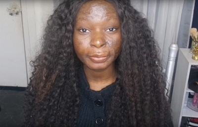 بالصور.. أصبحت فنانة ماكياج بعد سخرية الجميع من حروقها