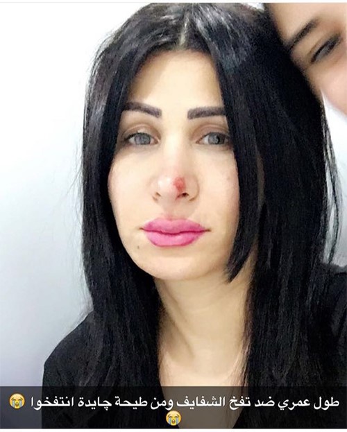 الإعلامية الجميلة سميرة عبدالله تتعرض لإصابة قوية بالوجه