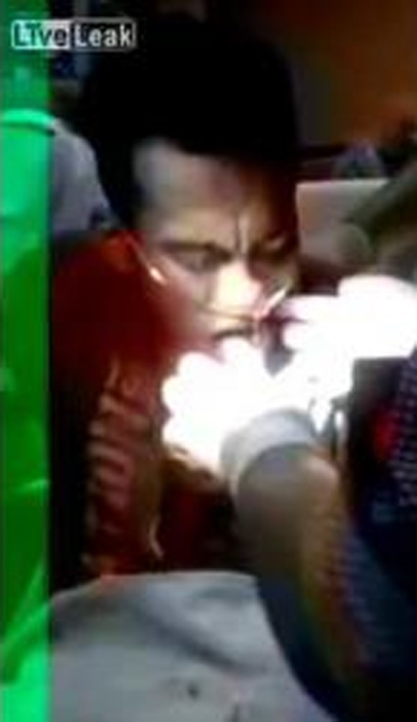 بالفيديو.. لحظة إخراج الأطباء لسمكة علقت في بلعوم صياد