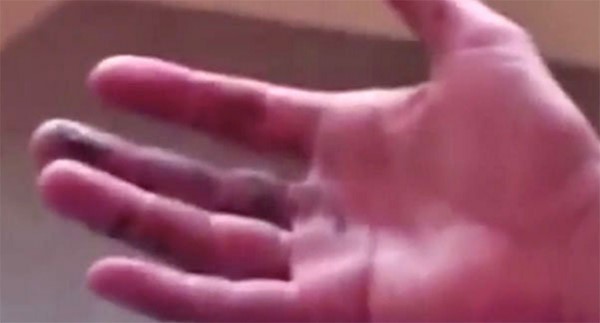 بالصور.. سيجارة إلكترونية تطيح لسان أميركي وأسنانه