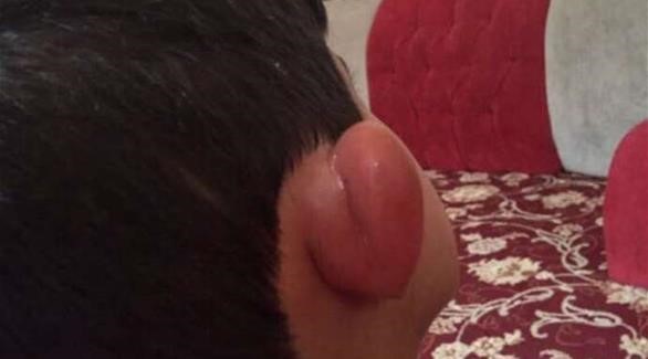 بالصور.. قرية سعودية تطلق مسابقة أجمل لسعة بعوض