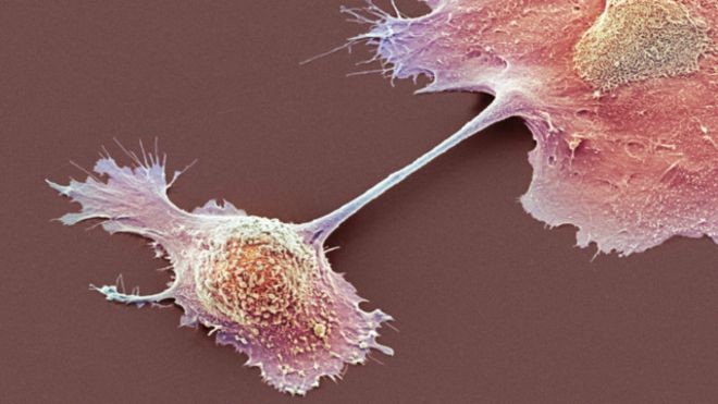 علاج جديد يبشر بتقدم في معالجة سرطان البنكرياس