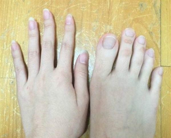صور صادمة لفتاة بأصابع قدمين بطول أصابع اليدين!