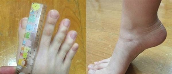 صور صادمة لفتاة بأصابع قدمين بطول أصابع اليدين!