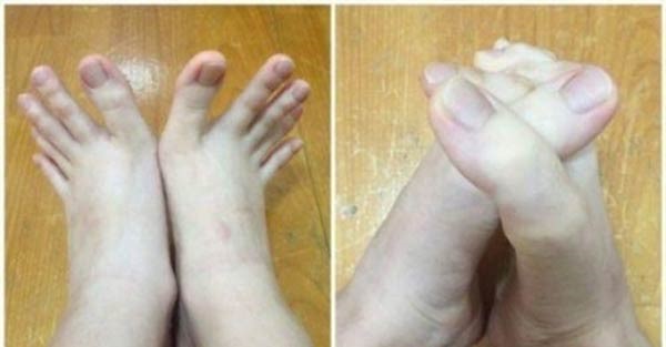 صور صادمة لفتاة بأصابع قدمين بطول أصابع اليدين!