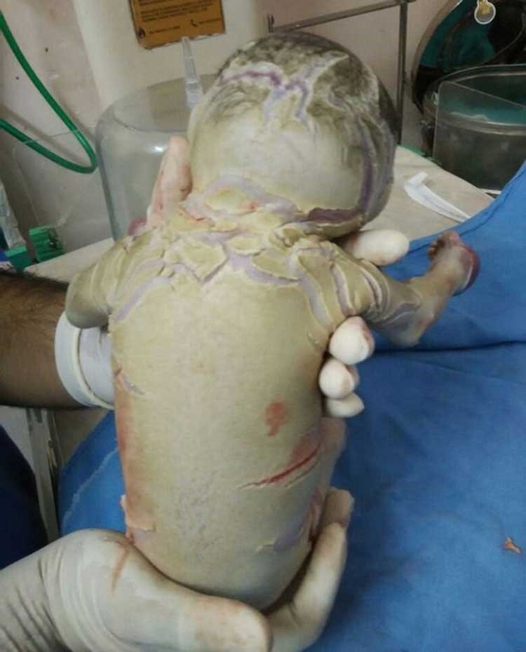 صور صادمة..  طفلة تولد بلا جلد تدهش الأطباء