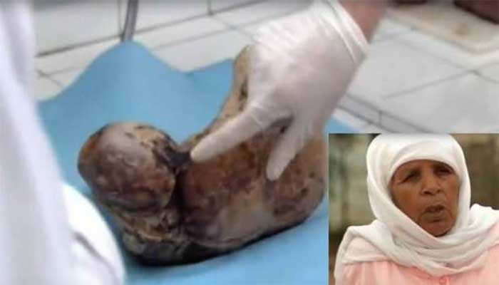 بالفيديو.. ظن الأطباء أنه ورم لكن ما وجدوه في رحمها صدم الكل! 