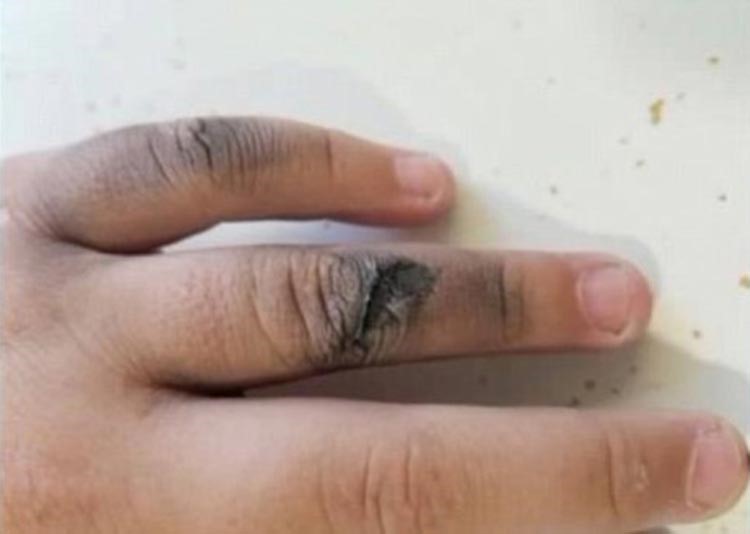 بالصور.. سيجارة إلكترونية تنفجر في وجه فتاة!