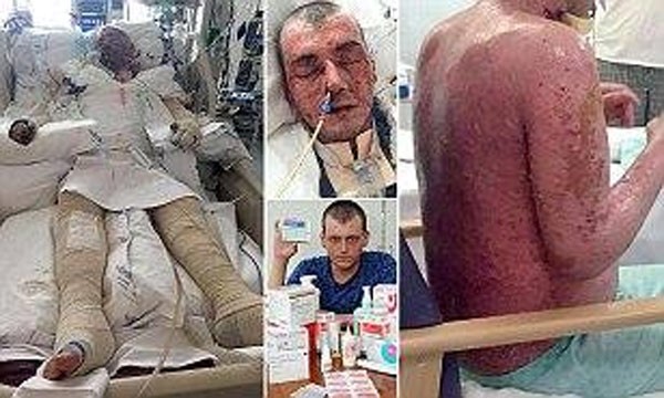  بالصور.. شاب يتعرض للحروق حيا بعد تناوله دواء خاطئا