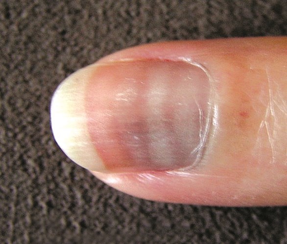 تلون اطراف الاصابع نوع من التليف بالجلد