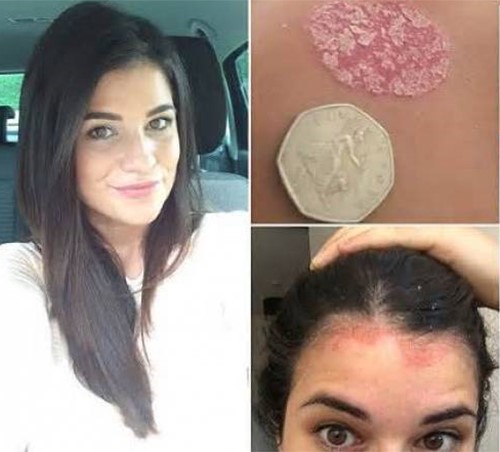 وجدوا هذه البقع على جسدها فأخرجوها من بركة السباحة ليكتشفوا أنها مصابة بـ..!