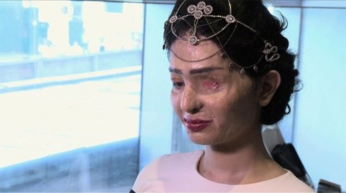 بالفيديو.. هندية مشوهة بالحمض الكاوي تشارك في اسبوع نيويورك للموضة 
