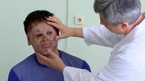 بالفيديو.. زراعة وجه لرجل.. من جلد معدته