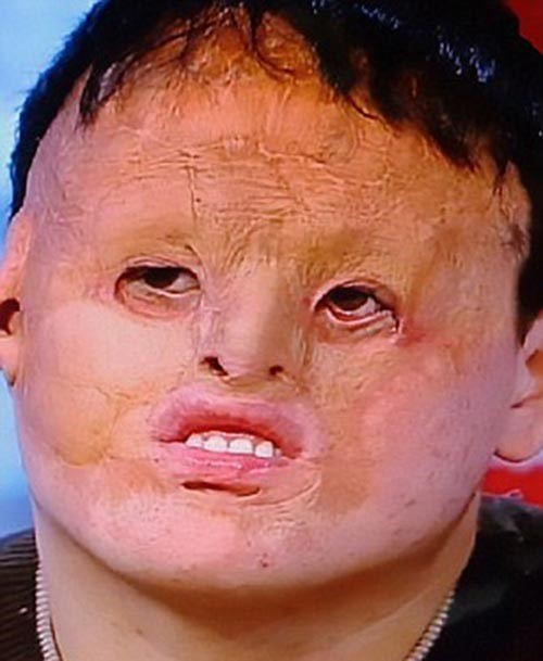 بالفيديو.. زراعة وجه لرجل.. من جلد معدته
