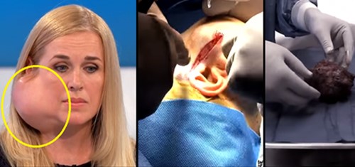 بالفيديو.. انتفاخ بشكل مرعب في وجهه إمرأة.. شاهد ماذا وجد الأطباء !