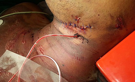 صمام أنبوب أوكسجين اخترق رقبة وفم عامل هندي!