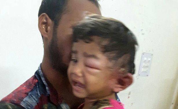 بالصور.. 80 دودة في أذن طفلة
