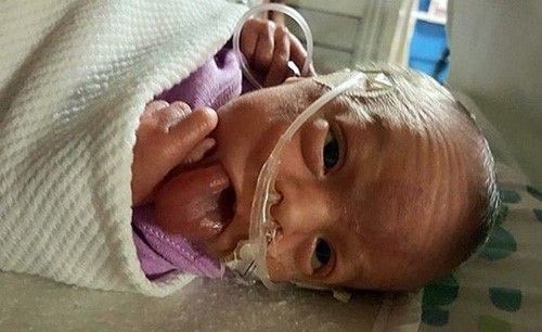 بالصور.. طفلة ولدت بلسانِ شخصٍ بالغٍ خرج من فمها.. تنفست وأكلت وابتسمت بعد 16 شهراً من مولدها !