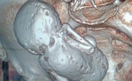 عجيب.. جزائرية عمرها 73 تحمل جنينا عمره 35 سنة!