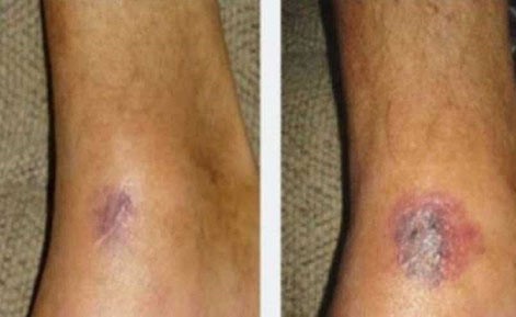 شعر بألمٍ في ساقه أثناء تنظيفه للأواني.. وبعد 4 أيام فوجئ بمرضه