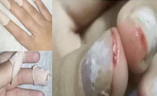 بالصور..معلمة في السعودية تقتلع أظافر طالبة في احدى المدارس بمهد الذهب