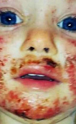 صور صادمة.. أصبحت هكذا بسبب قبلة من قريبتها... اليكم التفاصيل لتحذروا وشاهدوا كيف أصبحت الأن!