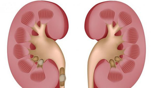 بالصور.. بعدما عجز الطب عن علاجها..رجل يبتكر طريقة لإخراج الحصى من كلى زوجته