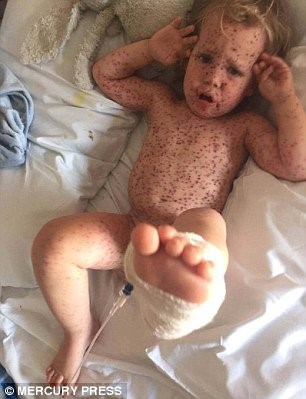 شاهد.. وجدت طفلها مغطى بالجروح والأطباء رفضوا لمسه!
