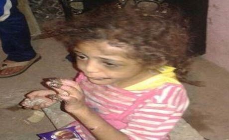 بالصور.. مصري تجرد من أبوته وعذب طفلته حرقاً.. والسبب صادم !
