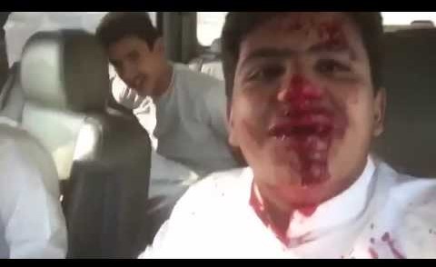 بالفيديو.. حدث يصور إصابته بسبب حادث.. وهل هذه الدماء حقيقية؟!