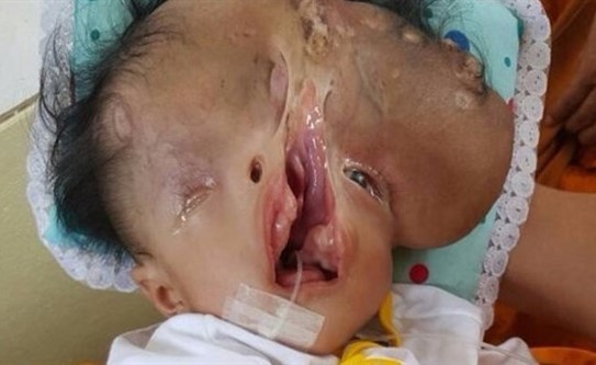 طفل يولد بلا جمجمة وبنصف وجه في تايلند