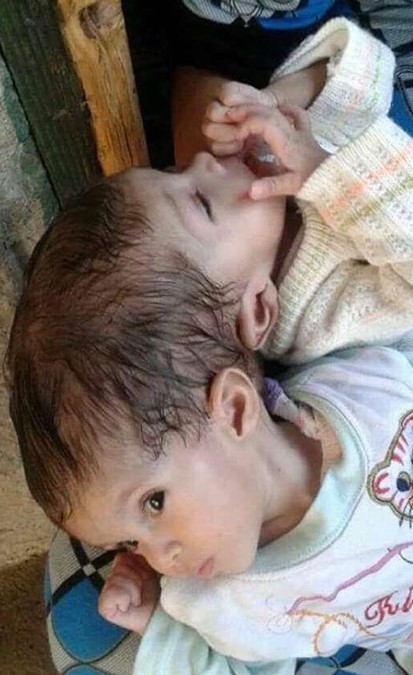 خادم الحرمين يأمر بعلاج التوأم السيامي المصري منه ومي