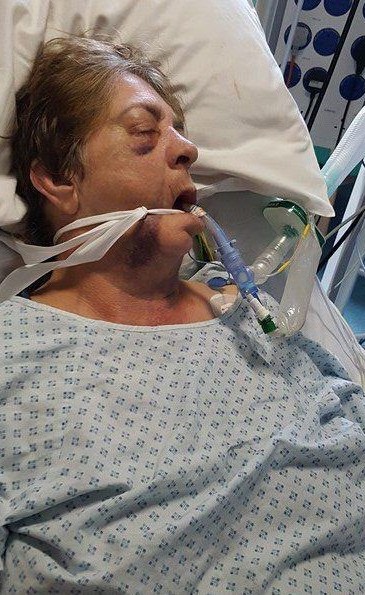 3 لصوص يهاجمون جدة معوقة ببيتها ويهشمون وجهها تماماً