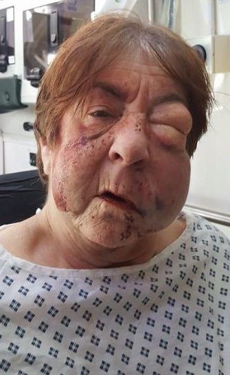 3 لصوص يهاجمون جدة معوقة ببيتها ويهشمون وجهها تماماً