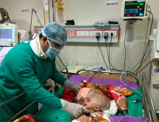 تعرف على الطفل صاحب الجمجمة الأكبر في العالم