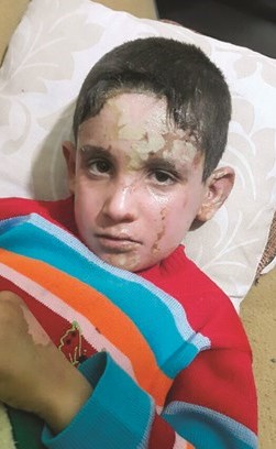 أحد الأطفال الجرحى السوريين اللاجئين في تركيا﻿