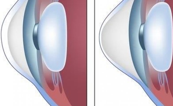 استشاري عيون يحذّر من تحدّب قرنيّة العين بسبب الفرك المستمر أو العدسات