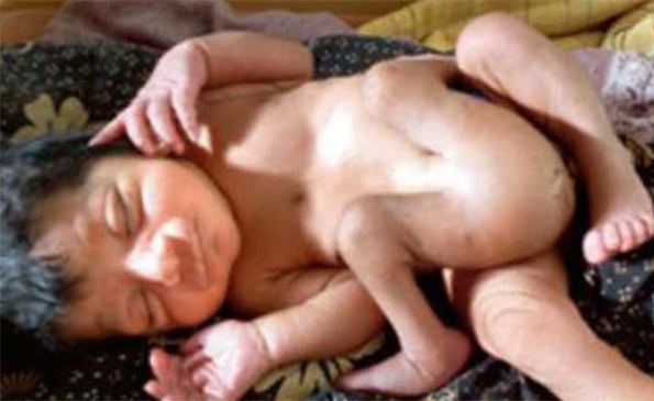 ولادة غريبة.. طفل بأربعة أرجل