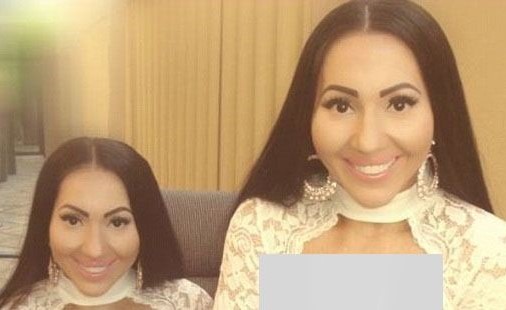 شاهد.. ربع مليون دولار لحصول توأم على نفس الصدر والحواجب