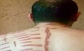 بالفيديو.. هذا ما فعله معالج شعبي بشاب سعودي باستخدامه "الكي" دون ترخيص
