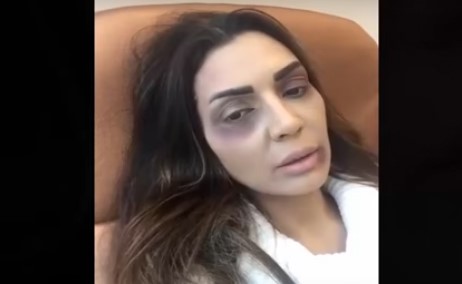 بالفيديو.. فنانة تصدم جمهورها بالكدمات على وجهها.. وتعترف" أنا انتهازية وشريرة" .. مالقصة !