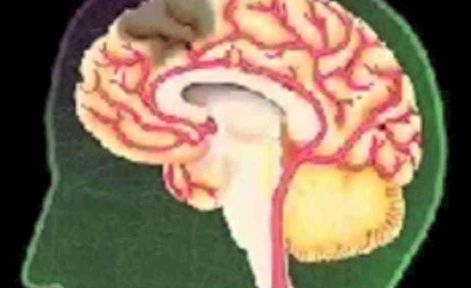 بالفيديو.. كيف تحدث السكتة الدماغية؟