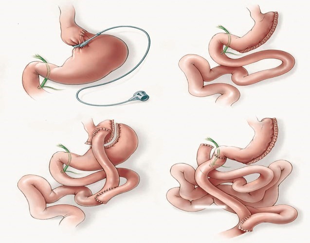 الأخطاء الطبية في عمليات التجميل وإنقاص الوزن.. هل توقفها اللوائح التنظيمية؟